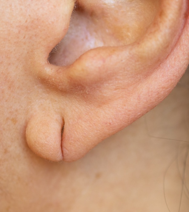 Résultat esthétique d'une chirurgie réparatrice du lobe d'oreille fendu ou déchiré par des boucles d'oreilles à Lyon à la Villa
