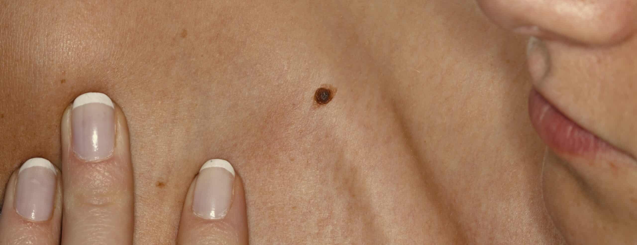 Quand s&rsquo;inquiéter d&rsquo;un grain de beauté&nbsp;?